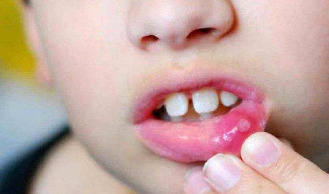 Trẻ bị nhiệt miệng phải làm sao? Cách chữa nhiệt miệng cho trẻ tại nhà